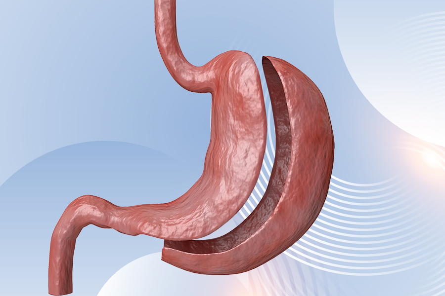 GastricSleeveSurgery