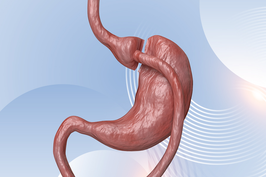 GastricBypass